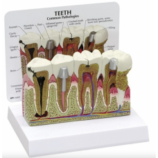Diseased Teeth and Gums Model - Myaskro