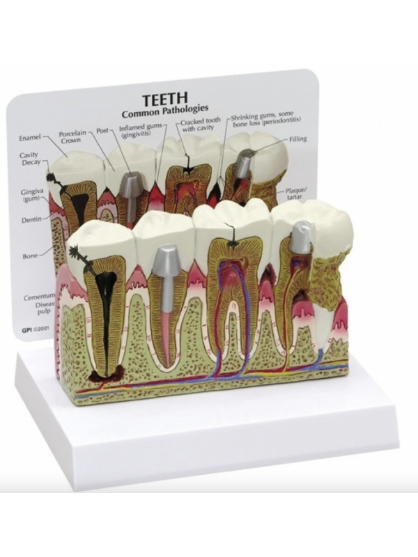 Diseased Teeth and Gums Model - Myaskro