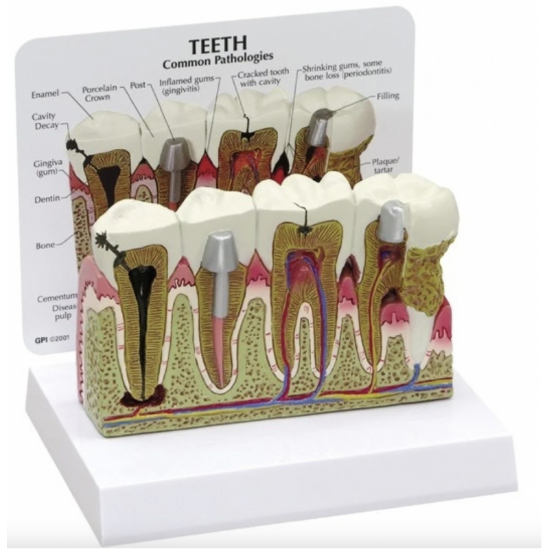 Diseased Teeth and Gums Model - Myaskro