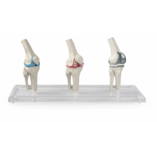 Knee Implant & Replacement Model Set - Myaskro