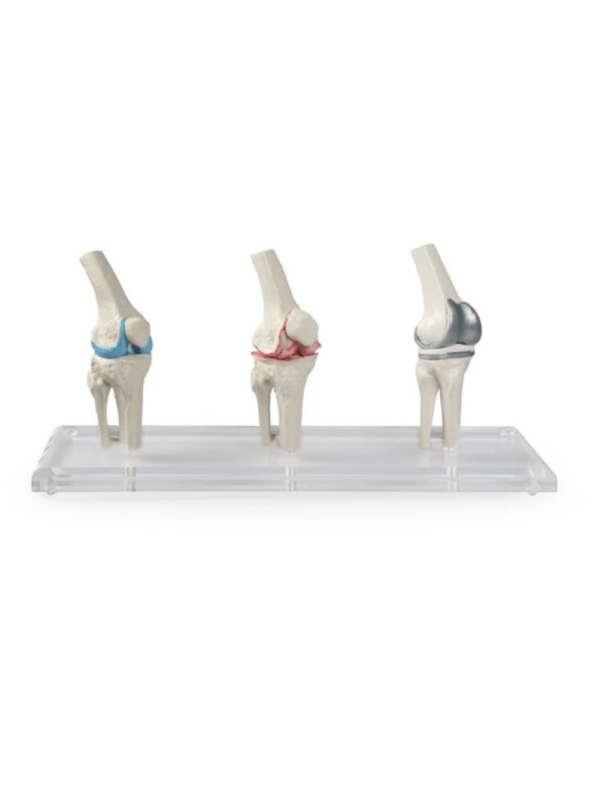 Knee Implant & Replacement Model Set - Myaskro