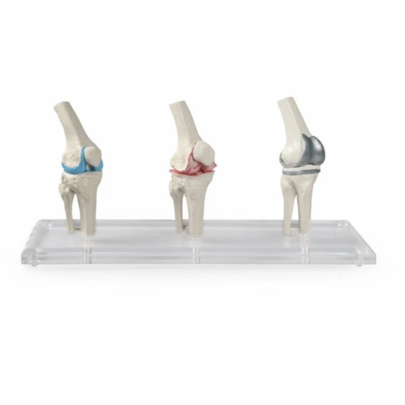 Knee Implant & Replacement Model Set - Myaskro