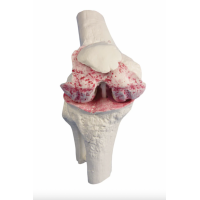 Knee Implant & Replacement Model Set - Myaskro