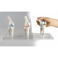 Knee Implant & Replacement Model Set - Myaskro