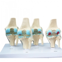 Osteoarthritis (OA) Educational Bundle | Knee & Spine 4 stage Degeneration Models + Spine Disorders & Knee Injuries Charts - Myaskro