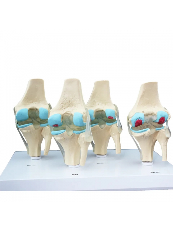 MYASKRO - Knee 4 Stage Arthritis Model