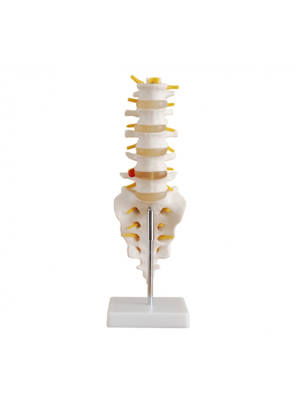 Lumbar Vertebrae With Sacrum, Coccyx and Herniated Disc (Life-Size) Anatomical Model