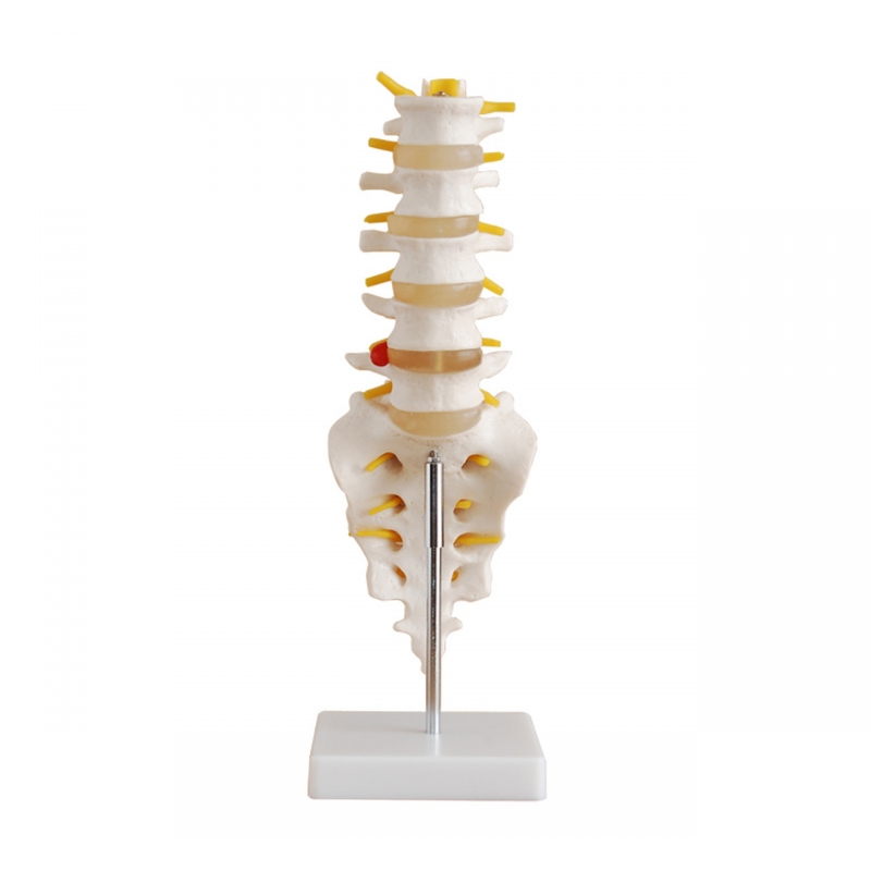 Lumbar Vertebrae With Sacrum, Coccyx and Herniated Disc (Life-Size) Anatomical Model