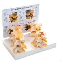 Osteoporosis Anatomical Models Bundle - Myaskro