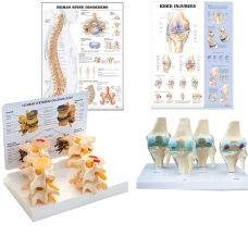 Osteoarthritis (OA) Educational Bundle | Knee & Spine 4 stage Degeneration Models + Spine Disorders & Knee Injuries Charts - Myaskro