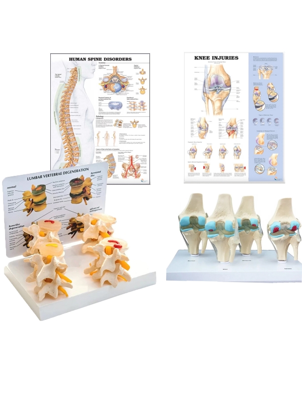 Osteoarthritis (OA) Educational Bundle | Knee & Spine 4 stage Degeneration Models + Spine Disorders & Knee Injuries Charts - Myaskro