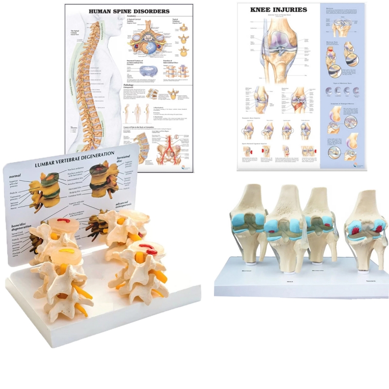 Osteoarthritis (OA) Educational Bundle | Knee & Spine 4 stage Degeneration Models + Spine Disorders & Knee Injuries Charts - Myaskro