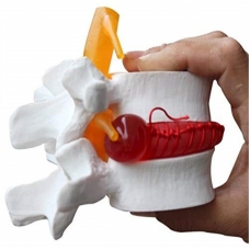 Lumbar Spine Herniated Disc Prolapse Demonstration Model